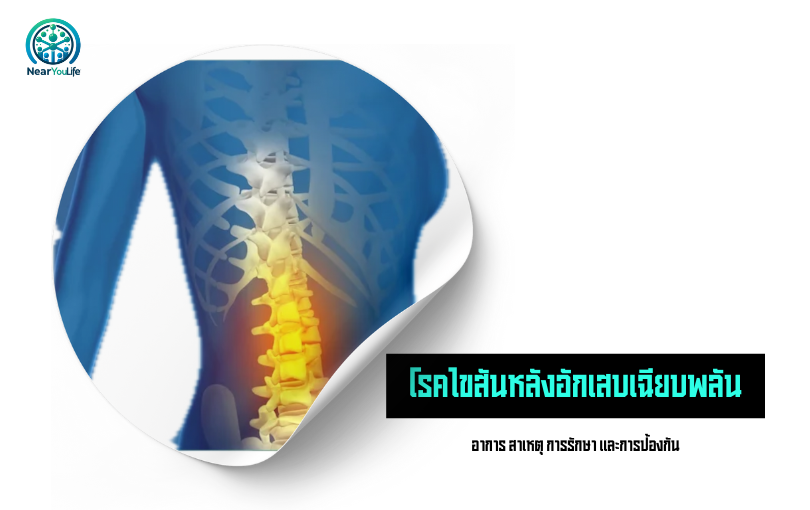 โรคไขสันหลังอักเสบเฉียบพลัน: อาการ สาเหตุ การรักษา และการป้องกัน